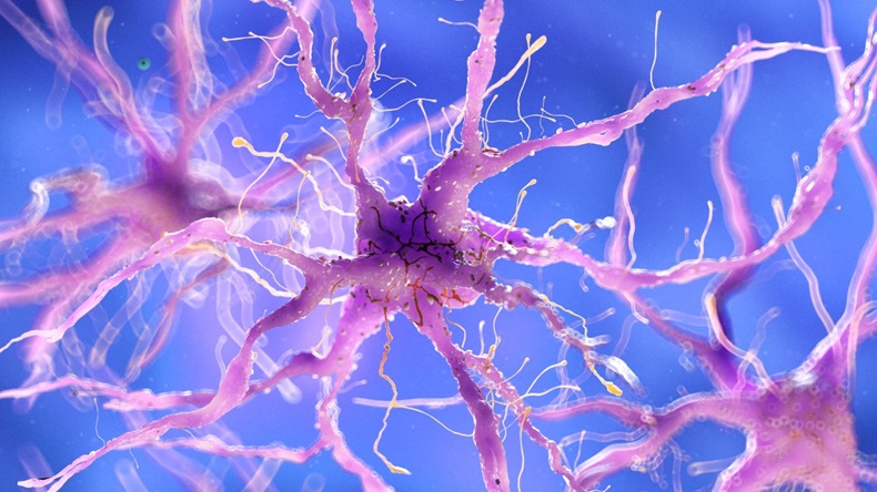 3d rendered medically accurate illustration of a damaged nerve cell