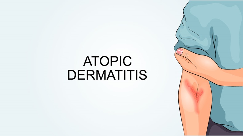 Atopic Dermatitis