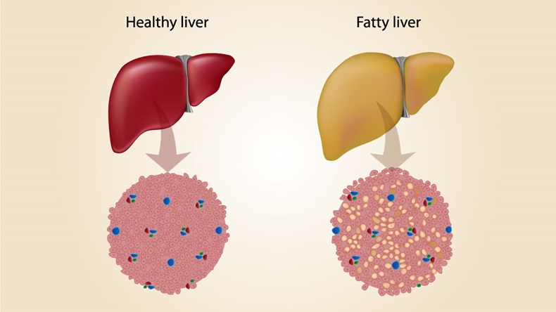 Fatty-Liver