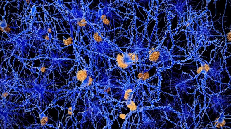 Computer illustration of amyloid plaques amongst neurons
