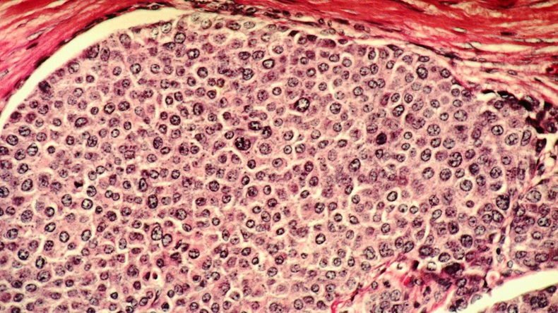 Close up of breast cancer.