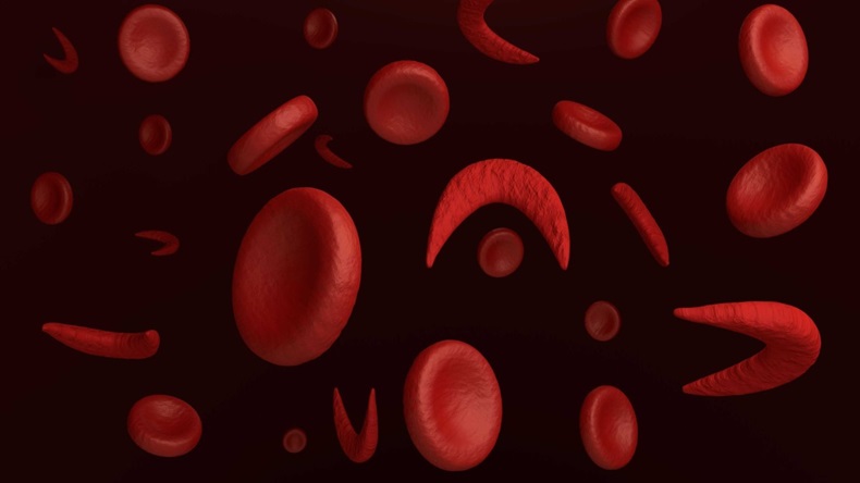 Sickle Cell Disease 