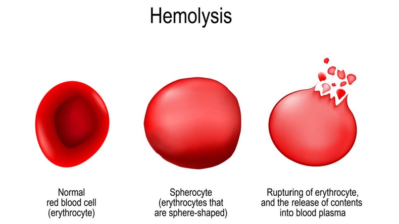 Hemolysis