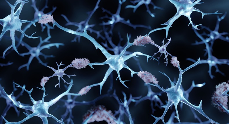 Alzheimer's disease, Amyloid plaques aggregates, 3d illustration
