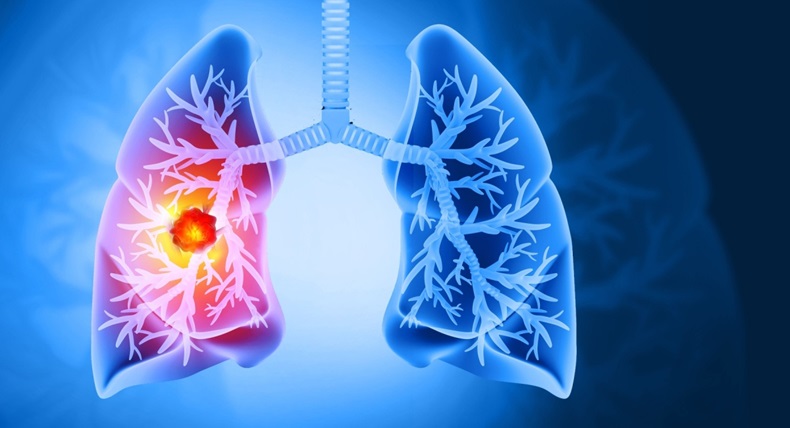 3d rendered, medically accurate illustration of lung cancer. showing presence of cancerous tumor inside the lungs