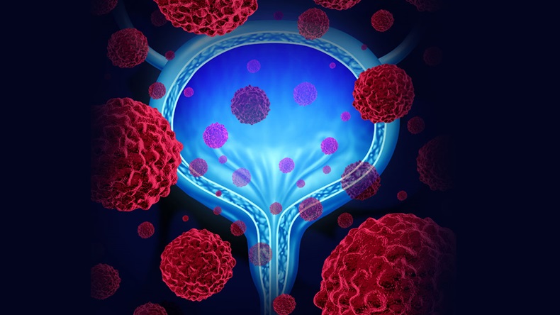 Bladder cancer medical concept as an anatomical organ symbol with microscopic malignant cells spreading in the human body as a health care 3D illustration.
