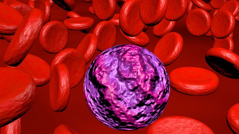Acute myeloid leukemia a 3d-Render