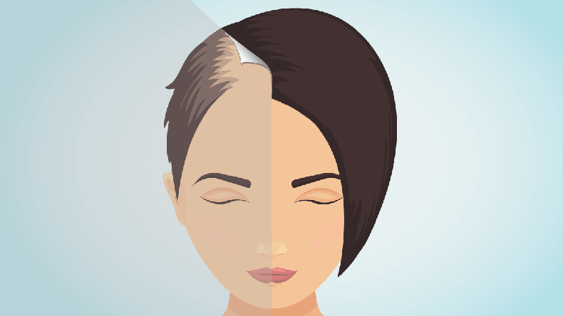 Front view of a balding woman before and after hair treatment. Divided image of the head. Two halves. Sticker revealing healthy scalp. Female alopecia. Isolated vector illustration.