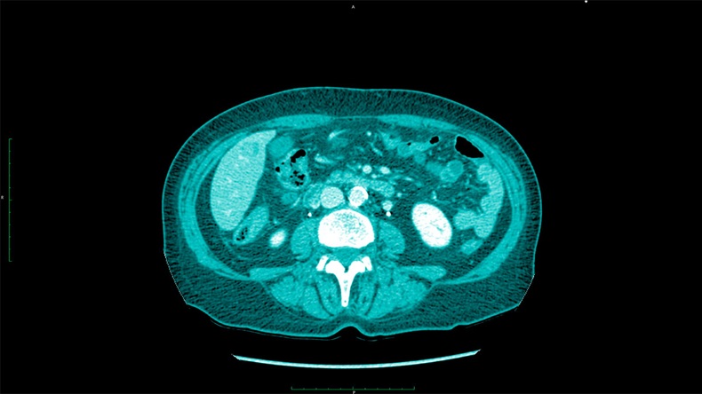 Liver cancer, CT scan upper abdomen.