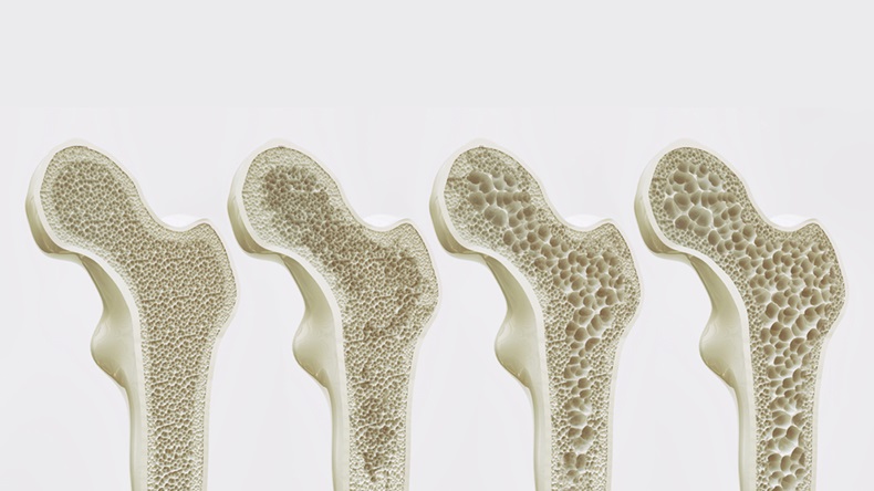 The four stages of osteoporosis - illustration - Illustration 