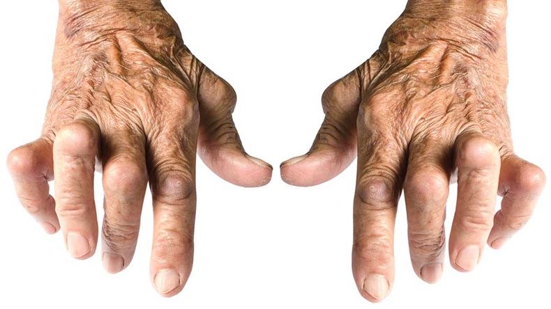 Rheumatoid-Arthritis-Hands_1200